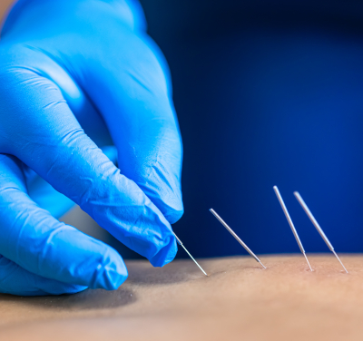Acupuncture